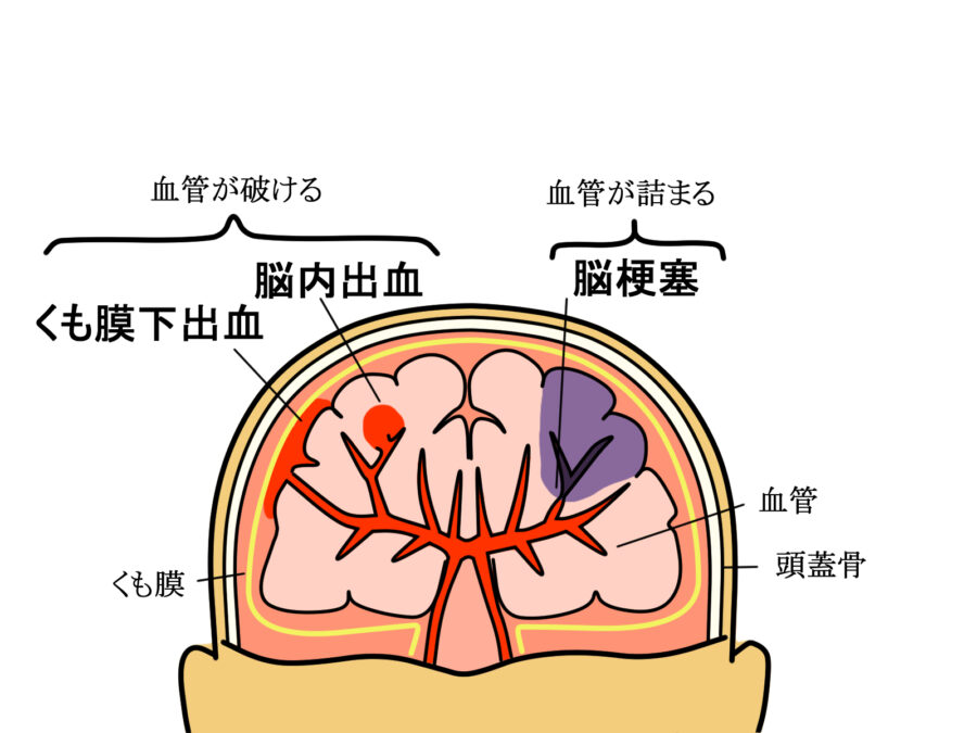 脳卒中の説明図